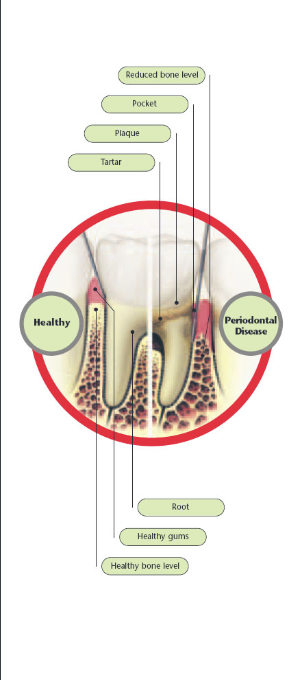 perio disease1